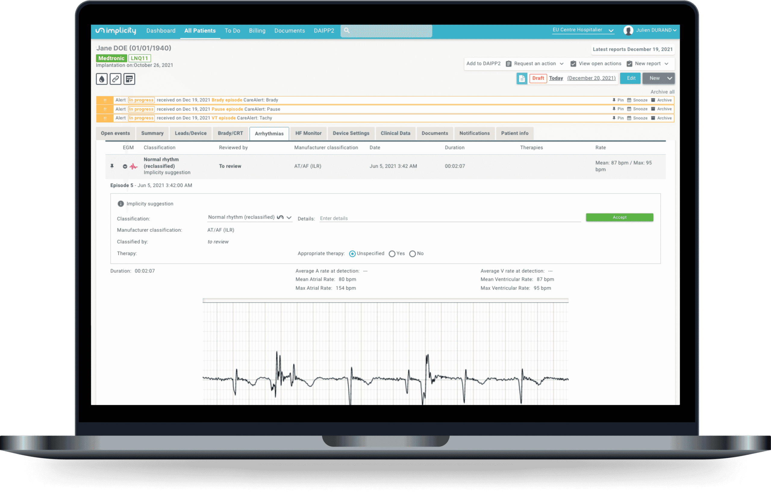 L’ILR ECG Analyzer affiché dans la plateforme Implicity : un épisode reclassé en rythme normal, avec son tracé ECG